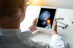 ADROTERAPIA PER IL CORDOMA DEL BASICRANIO